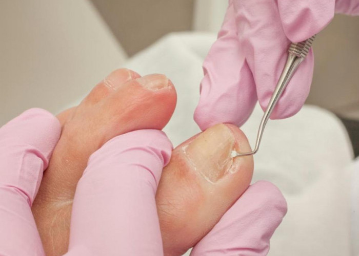 Tips Mengobati Kuku Cantengan agar Cepat Sembuh