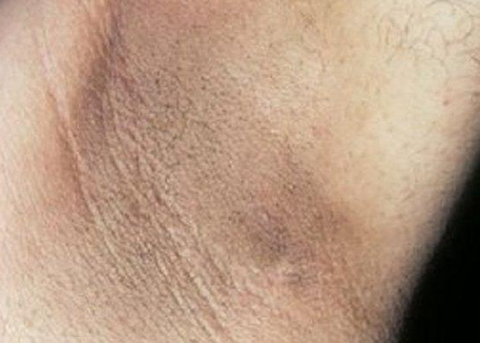 Hanya Gunakan Bahan Alami, Ketiak Bau dan Menghitam Bisa Menghilang Tanpa Sisa