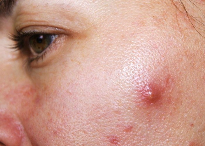 Ketahui Ini Ciri-ciri Jerawat yang Disebabkan Wajahmu tak Cocok Gunakan Produk Skincare