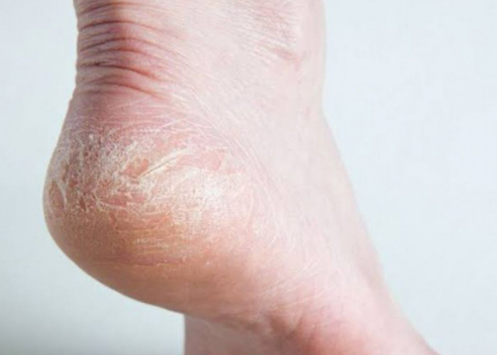 Kaki Pecah-Pecah? Ini Solusi Ampuh yang Bisa Dilakukan