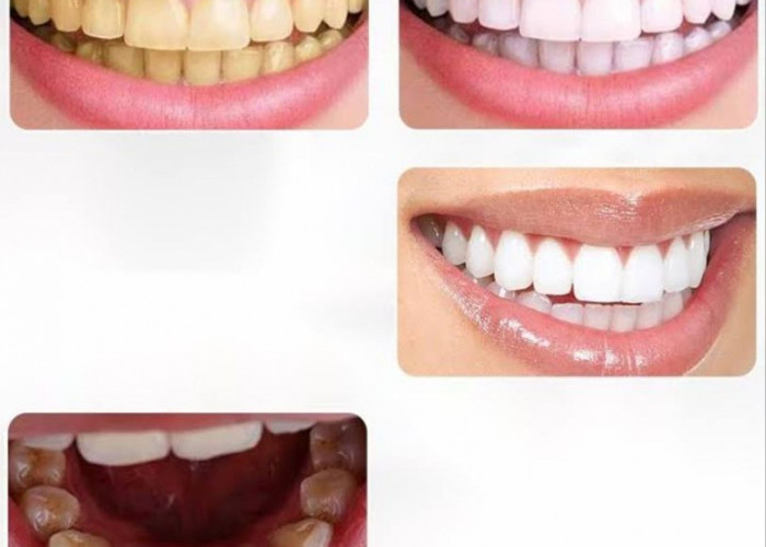 Cuma 2 Bahan! Ini Cara Ampuh Memutihkan Gigi Secara Permanen dalam 7 Hari