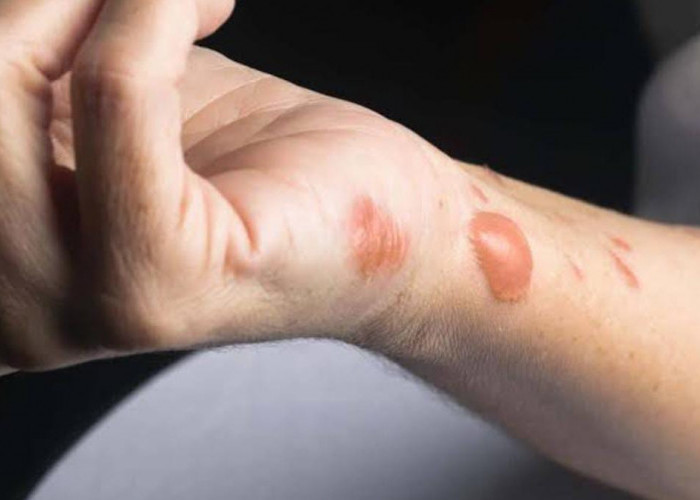 Kenali Tanda Dehidrasi dan Cara Penyembuhan Luka Bakar Sebelum Menjadi Lebih Parah