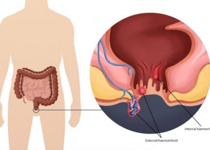 Jangan Khawatir, Ini Cara Alami untuk Mengatasi Ambeien