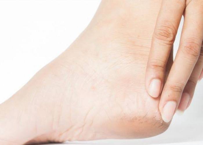 Tak Hanya Karena Kebanyakan Berdiri, Nyeri di Tumit Juga Bisa Disebabkan Hal Ini