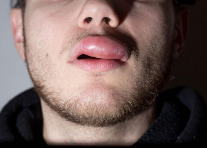 Bibir Bengkak Bikin Engga Pede? Kenali Penyebab dan Cara Mengatasinya