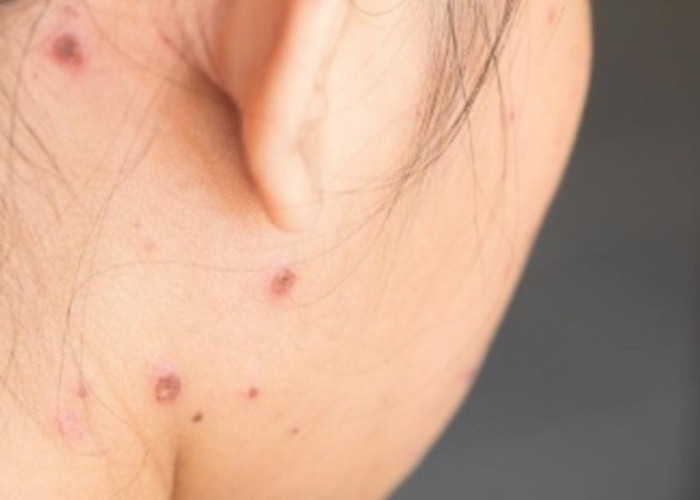 5 Pilihan Obat Cacar Air agar Cepat Kering dan Hilang