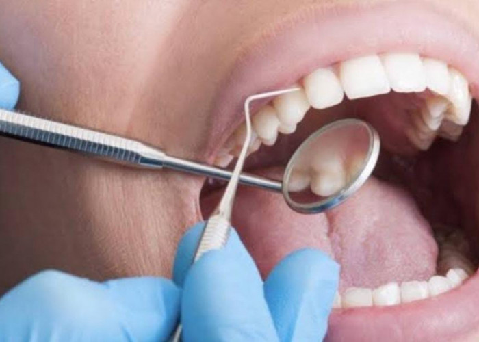 Gratis! Ini Cara dan Syarat untuk Scaling Gigi Gunakan BPJS Kesehatan
