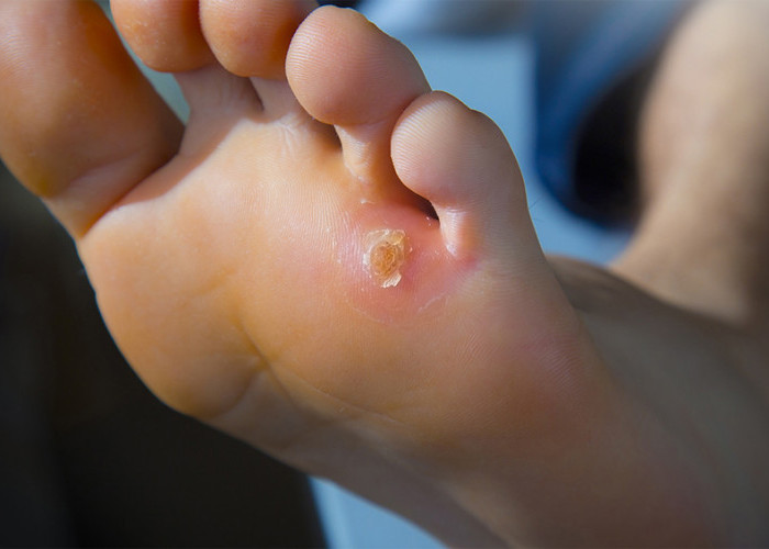 Obat Alami Lebih Efektif? Kenapa Tidak, Ini Obat Mata Ikan di Kaki yang Terbukti Ampuh