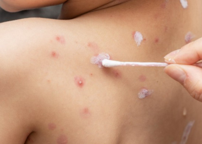 Kenali Obat Alami Cacar Air Pada Anak, Makanan Dan Minuman Yang Dianjurkan Untuk Dikonsumsi