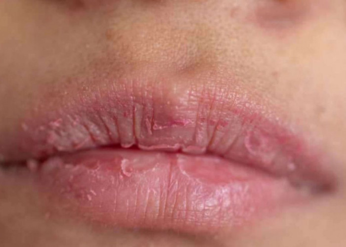 Tanpa Disadari, Ini 6 Kebiasaan Sehari-hari yang Bikin Bibir Kering dan Mengelupas