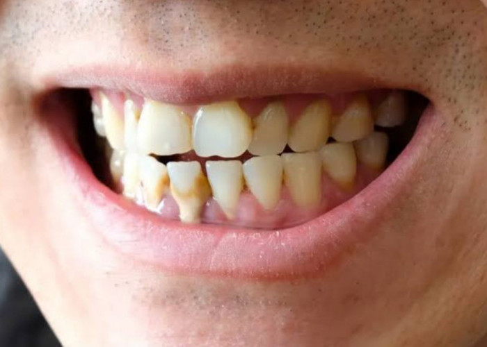 Kebiasaan Sederhana yang Ampuh Mencegah Munculnya Karang Gigi