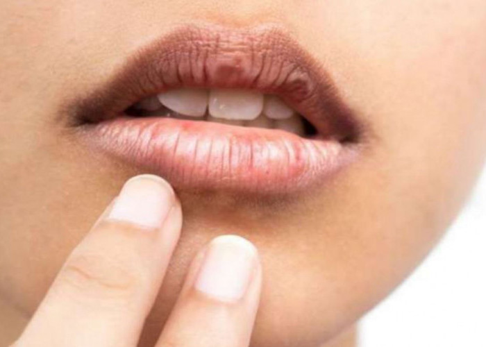 Bibir Hitam Tak Selalu karena Pakai Lipstik, Ini 5 Penyebab Aslinya