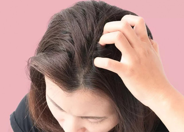 Kutu Rambut Bisa Sangat Mengganggu, Ini Cara Lepas dari Gangguan Ini