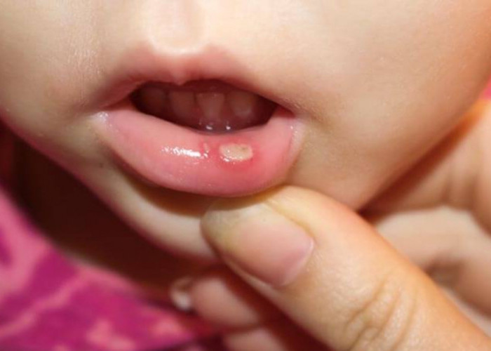Wajib Coba, Obat Alami Ampuh Untuk Sariawan Anak Ada Untuk Bayi Juga