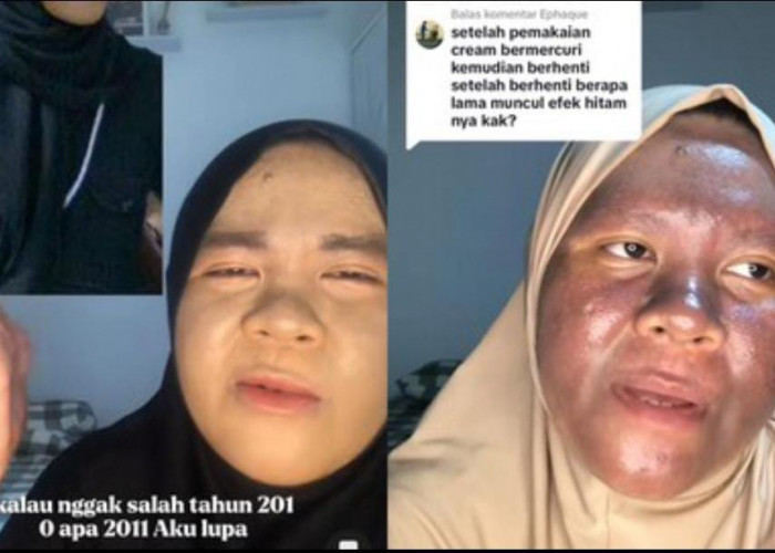 Bertahun-Tahun Pakai Skincare Mengandung Merkuri, Wajah Glowing Wanita Kalimantan Ini Menggosong
