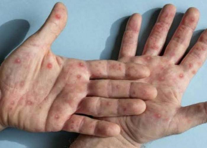 Tumbuh Liar di Pekarangan Rumah, Ternyata Jenis Tanaman Cacar Air Ini Sangat Baik untuk Kesehatan Kulit