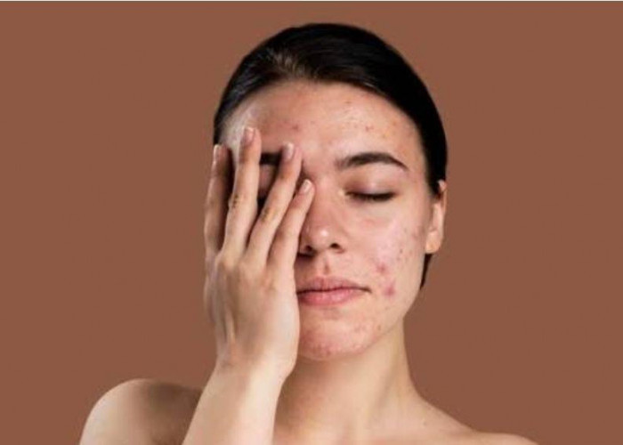 Bisa Jadi Ada Tanda Alergi, Jika Jerawat Tumbuh di Area Alis