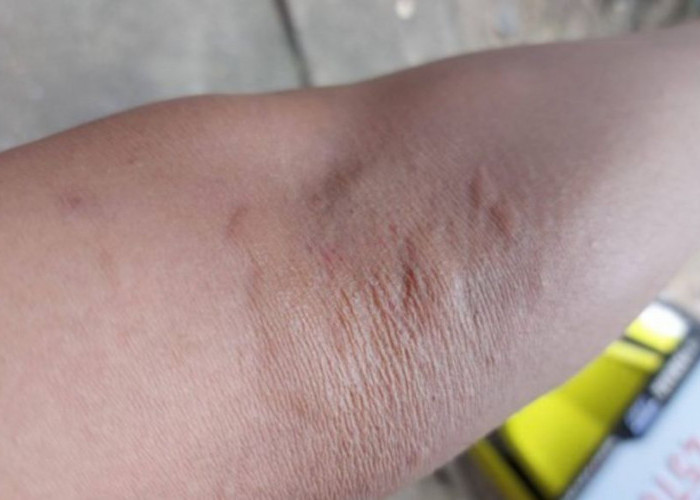 Bukan Digaruk, Ini Cara Mudah Menghilangkan Gatal Akibat Ulat Bulu