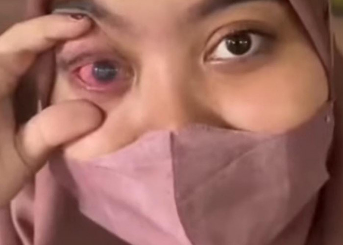 Diduga Iritasi Setelah Memakai Eyelash atau Bulu Mata Palsu, Kornea Mata Perempuan Cantik Asal Jogja Terluka