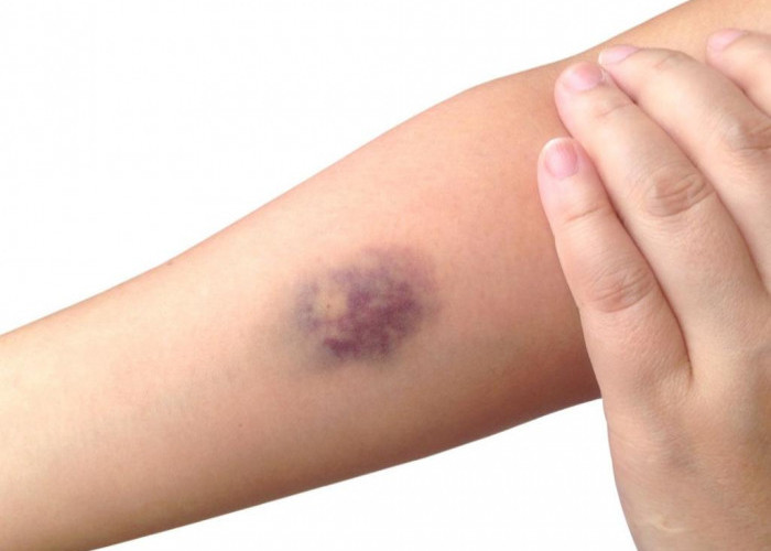 Waspada Memar Tanpa Sebab dan Cara Penanganan yang Tepat 