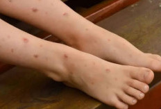 4 Cara Mudah Hilangkan Bekas Luka yang Menghitam di Kaki dan Sudah Terbukti Efektif