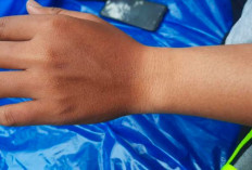 3 Cara Efektif Mengatasi Kulit Tangan dan Kaki yang Belang