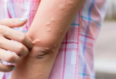 Jangan Sampai tidak Tau, Kenali Obat Alami Ampuh Sembuhkan Biduran, Ternyata Ada Juga Hal yang Dilarang 