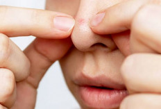 Mengganggu Penampilan, Ini Cara Ampuh untuk Menghilangkan Komedo Hitam di Wajah