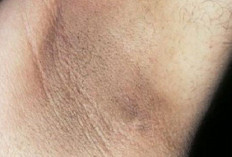 Hanya Gunakan Bahan Alami, Ketiak Bau dan Menghitam Bisa Menghilang Tanpa Sisa