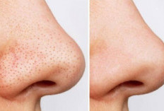 Jangan Sembarang Pencet, Begini Cara Alami untuk Menghilangkan Komedo Hitam di Hidung