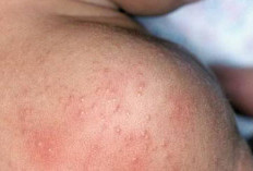 Nggak Perlu Obat Kimia, Begini Cara Alami yang Ampuh Mengobati Biang Keringat Pada Anak