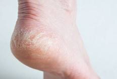 Kaki Pecah-Pecah? Ini Solusi Ampuh yang Bisa Dilakukan