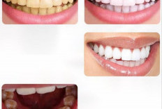Cuma 2 Bahan! Ini Cara Ampuh Memutihkan Gigi Secara Permanen dalam 7 Hari