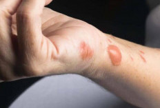 Kenali Tanda Dehidrasi dan Cara Penyembuhan Luka Bakar Sebelum Menjadi Lebih Parah