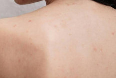 Bukan Hanya Wajah, Ternyata Bagian Tubuh Ini Juga Kerap Muncul Bintik Hitam