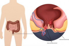 Jangan Khawatir, Ini Cara Alami untuk Mengatasi Ambeien