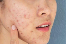 Bukan Jerawat Biasa, Jika Terdapat di Dagu dan Leher Bisa Jadi itu Jerawat Hormonal
