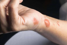 8 Obat Luka Bakar Salep yang Ampuh dan Cara Lengkap untuk Perawatan Luka yang Benar