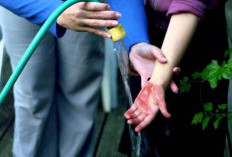 Pertolongan Pertama Luka Bakar Ini Bisa Menyebabkan Infeksi, Termasuk Mengoles Odol dan Kompres Es Batu