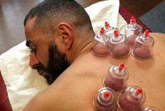 5 Manfaat Terapi Bekam untuk Kesehatan yang Wajib Kamu Ketahui!