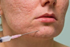 4 Perawatan yang Bisa Hilangkan Bopeng di Wajah secara Cepat dan Ampuh