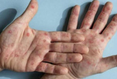 Tumbuh Liar di Pekarangan Rumah, Ternyata Jenis Tanaman Cacar Air Ini Sangat Baik untuk Kesehatan Kulit