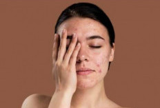 Bisa Jadi Ada Tanda Alergi, Jika Jerawat Tumbuh di Area Alis