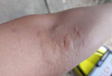 Bukan Digaruk, Ini Cara Mudah Menghilangkan Gatal Akibat Ulat Bulu