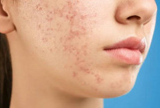 Para Acne Fighter Wajib Tahu, Ada Bahan Alami untuk Mengatasi Jerawat Bandel, Auto Mulus